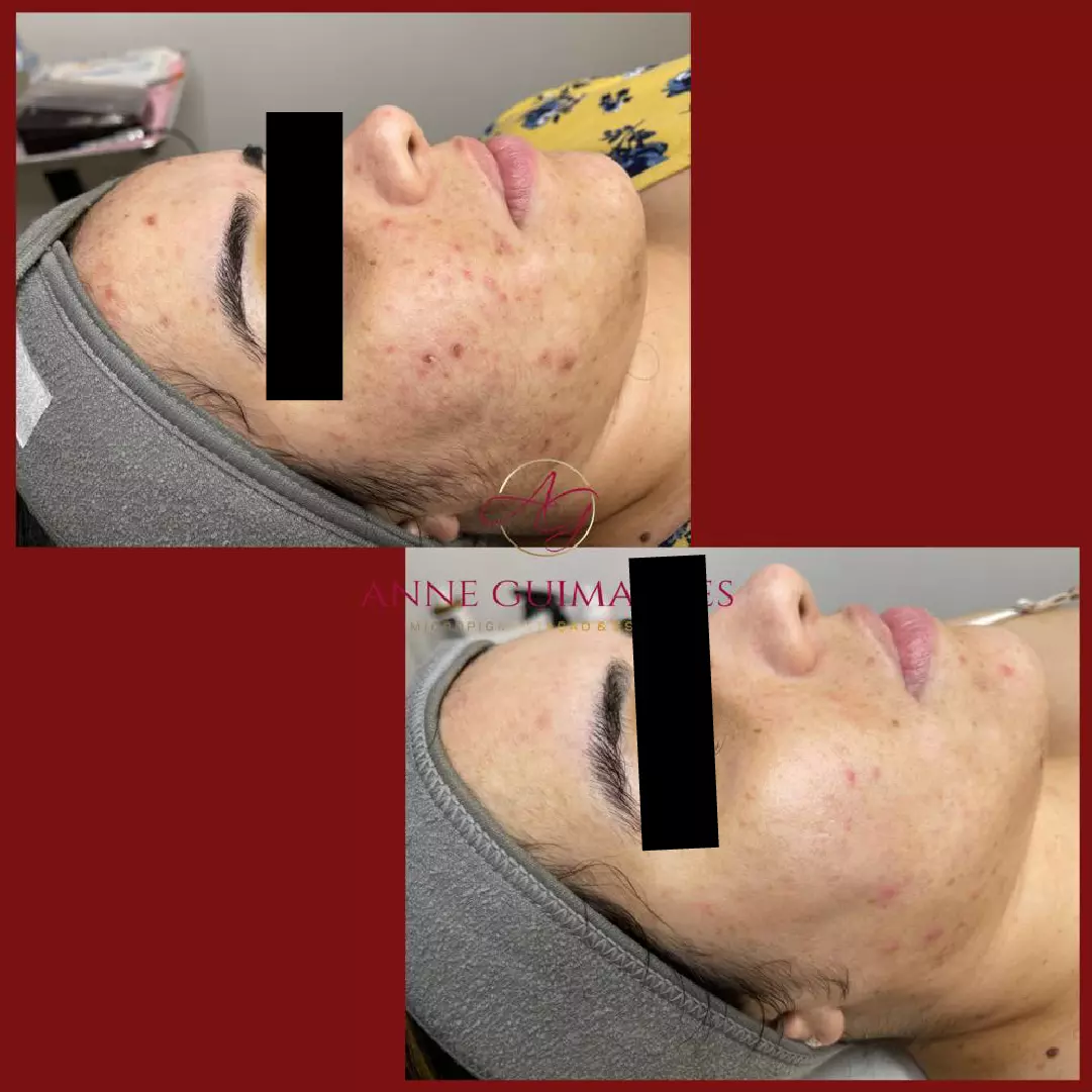 Home 7 AnyConv.com__anti acne 2.1