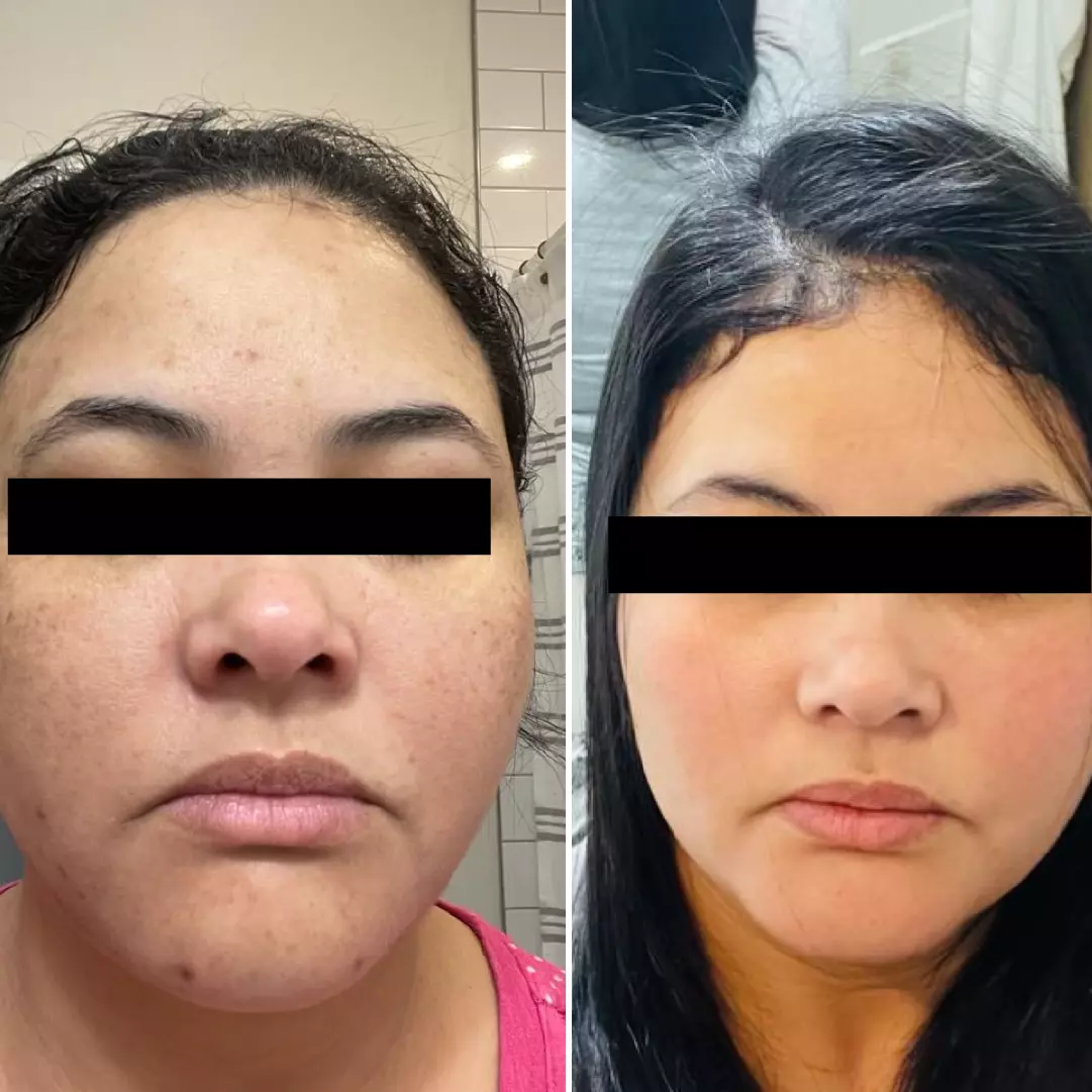 Home 6 AnyConv.com__anti acne 3.1