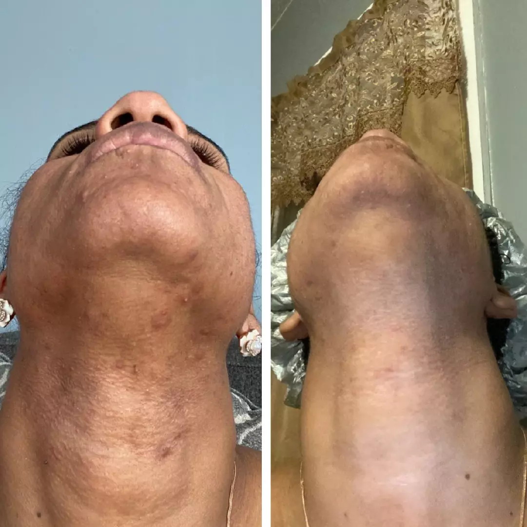 Home 4 AnyConv.com__anti acne 4.1